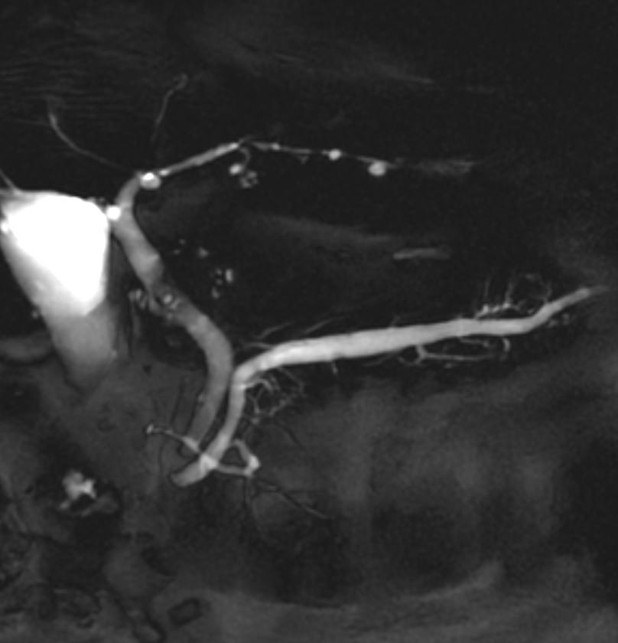 深層学習再構成を用いた高精細MRI