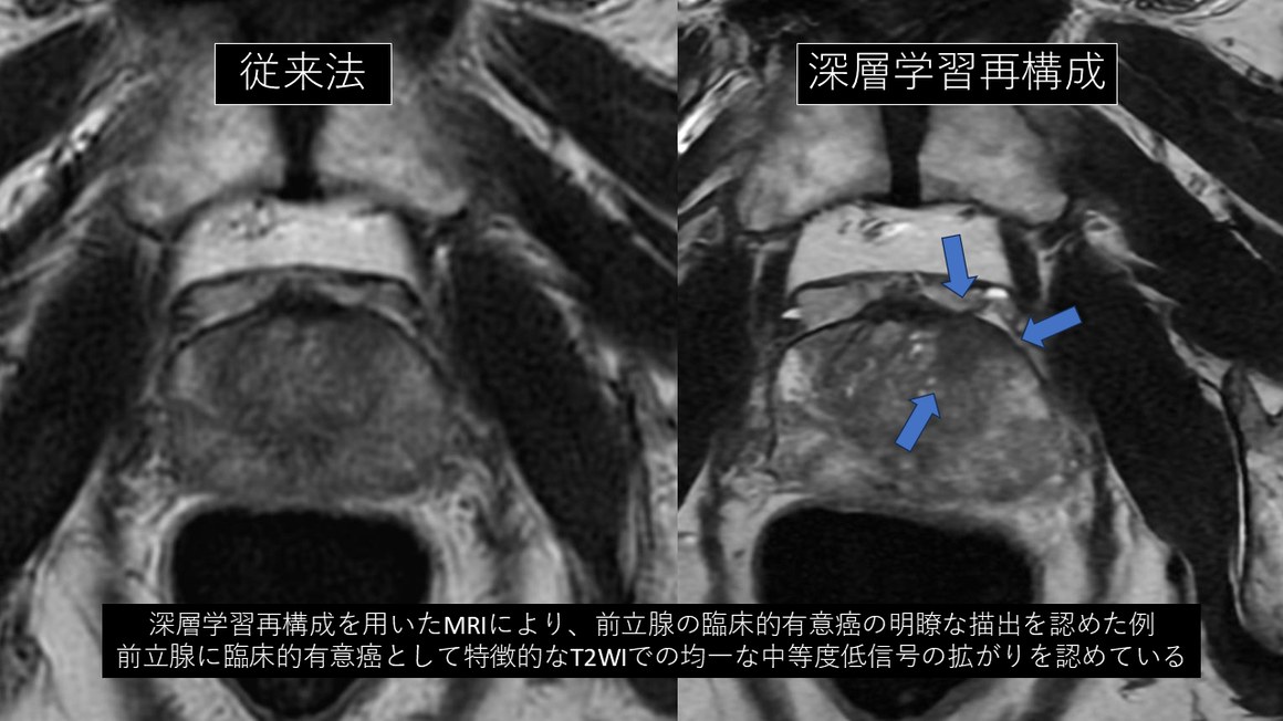 深層学習再構成による前立腺MRI(従来法との比較)