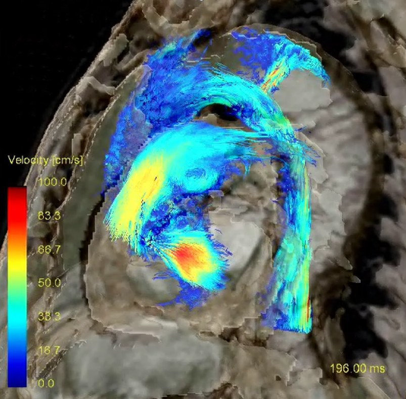 心臓内血流の4D Flow MRI(速度マップ)