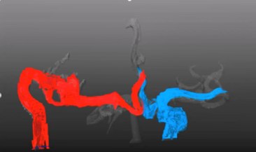 4D Flow MRIによる血流ストリームライン