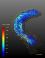 大血管の4D Flow MRI(速度マップ)