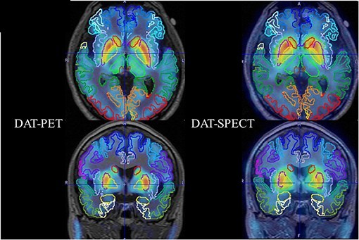 同一被験者の DAT-PET と DAT-SPECT の実画像