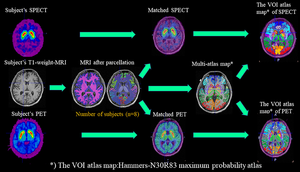 DAT-SPECT・DAT-PET・T1-MRI を統合する解析ワークフロー