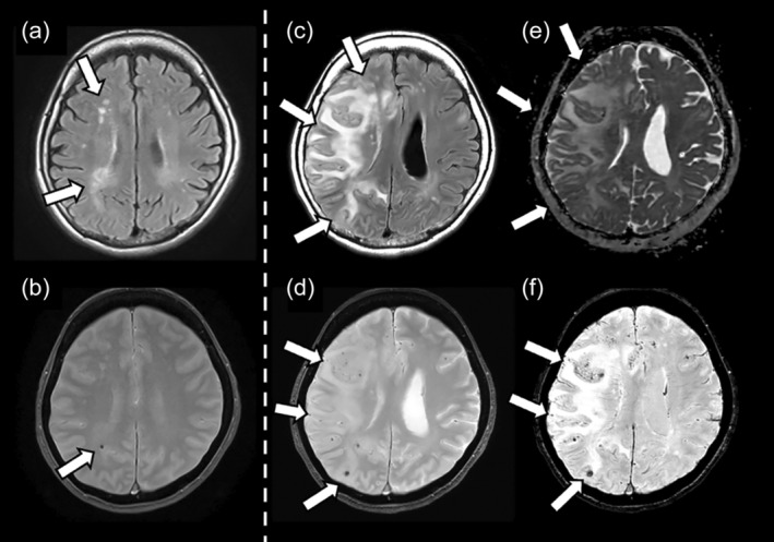 Brain MRI of severe ARIA — FLAIR edema (ARIA-E) and extensive microbleeds (ARIA-H) after lecanemab