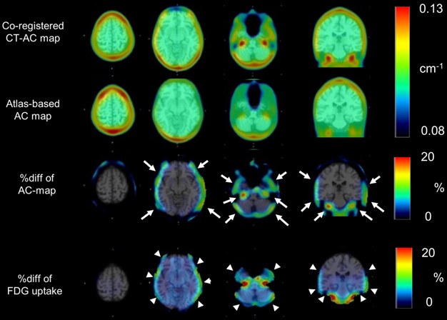 Evaluation of Atlas-Based Attenuation Correction for Integra