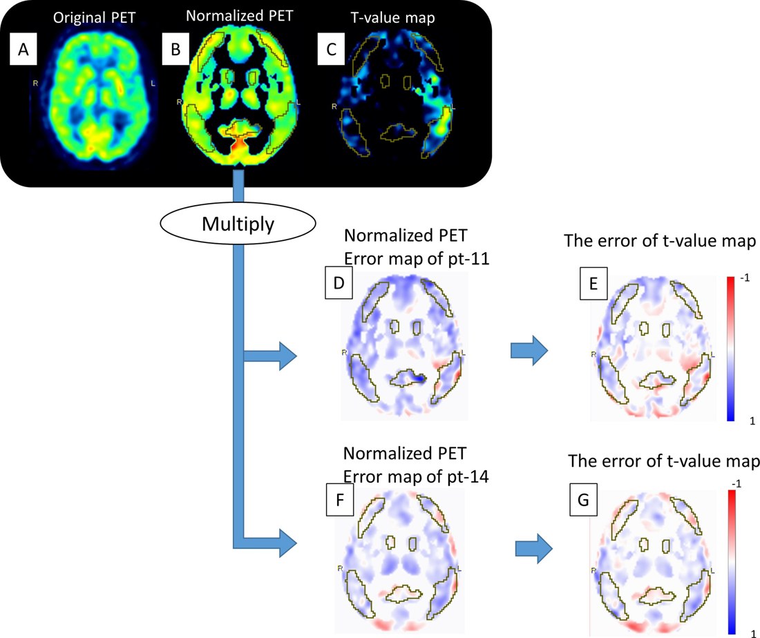 The impact of atlas-based MR attenuation correction on the d