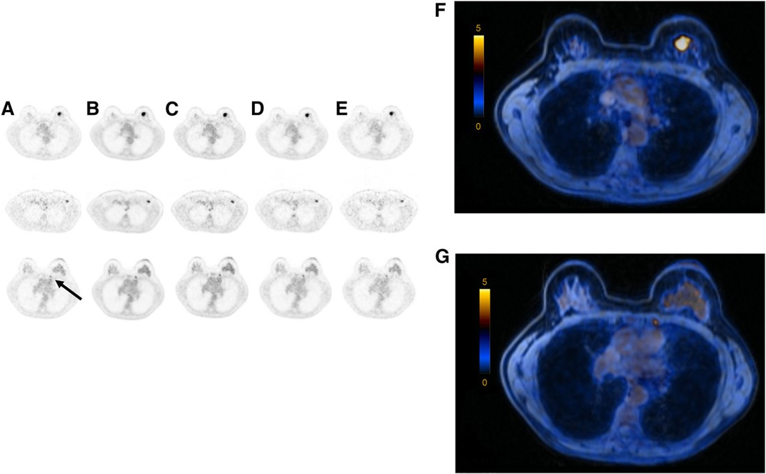 Feasibility of 18F-FDG Dose Reductions in Breast Cancer PET/