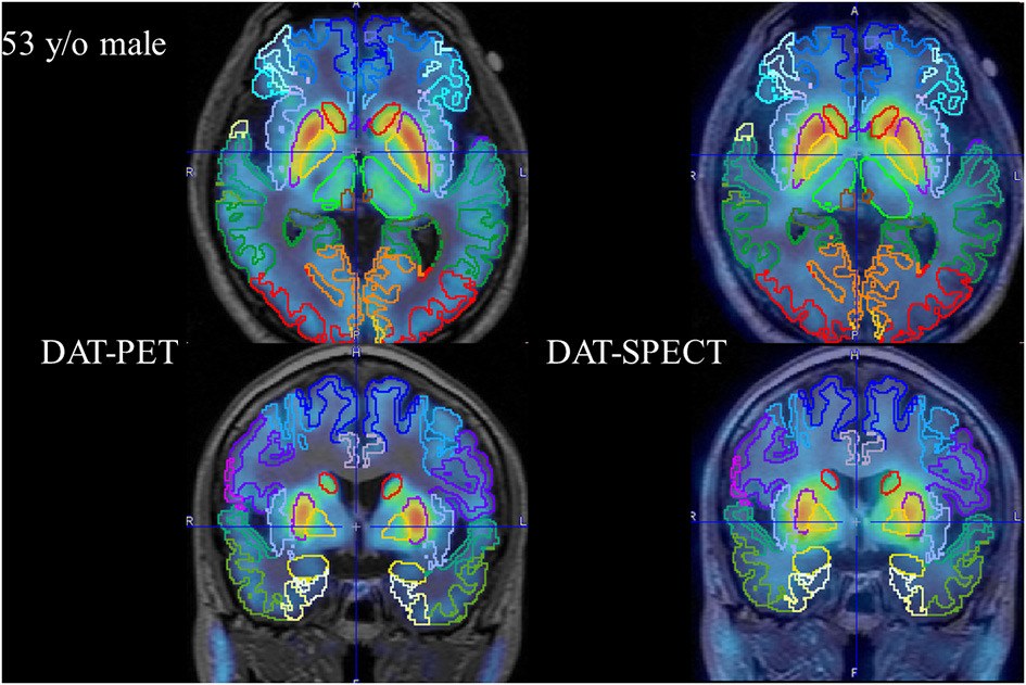 Multi-Atlas MRI-Based Striatum Segmentation for 123I-FP-CIT