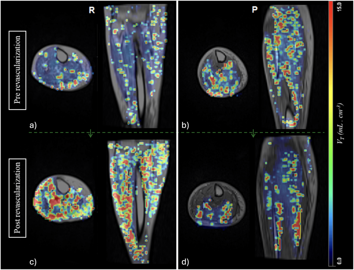 FAZA PET/MR of the lower limb — tissue hypoxia (VT map) pre vs post revascularization in chronic limb-threatening ischemia