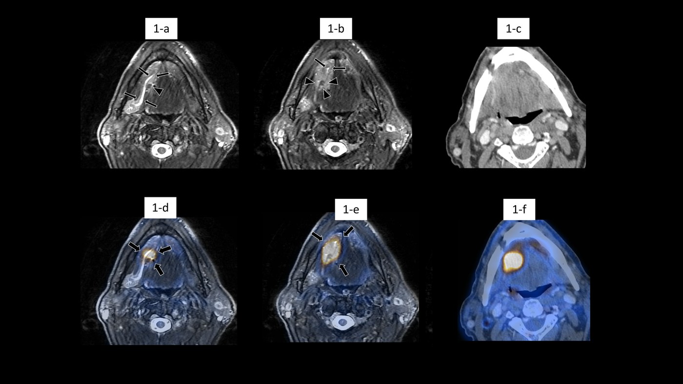 PET+MR versus PET/CT in the initial staging of head and neck