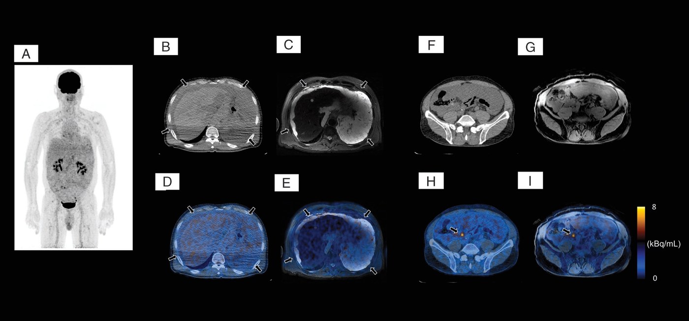 PET/MR Outperforms PET/CT in Suspected Occult Tumors