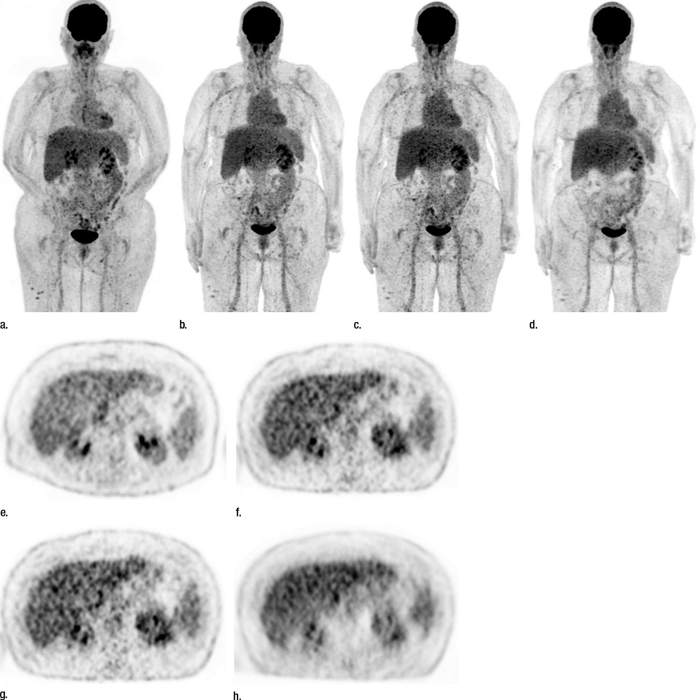 Reduction of 18F-FDG Dose in Clinical PET/MR Imaging by Usin