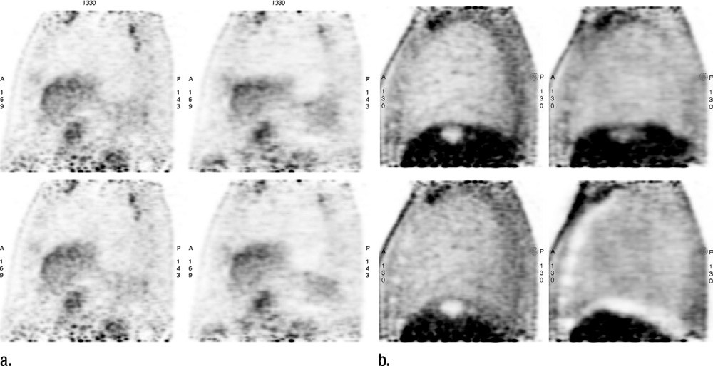Effect of Time-of-Flight Information on PET/MR Reconstructio