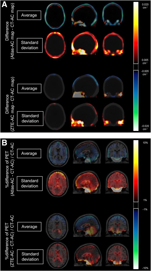 Clinical Evaluation of Zero-Echo-Time Attenuation Correction
