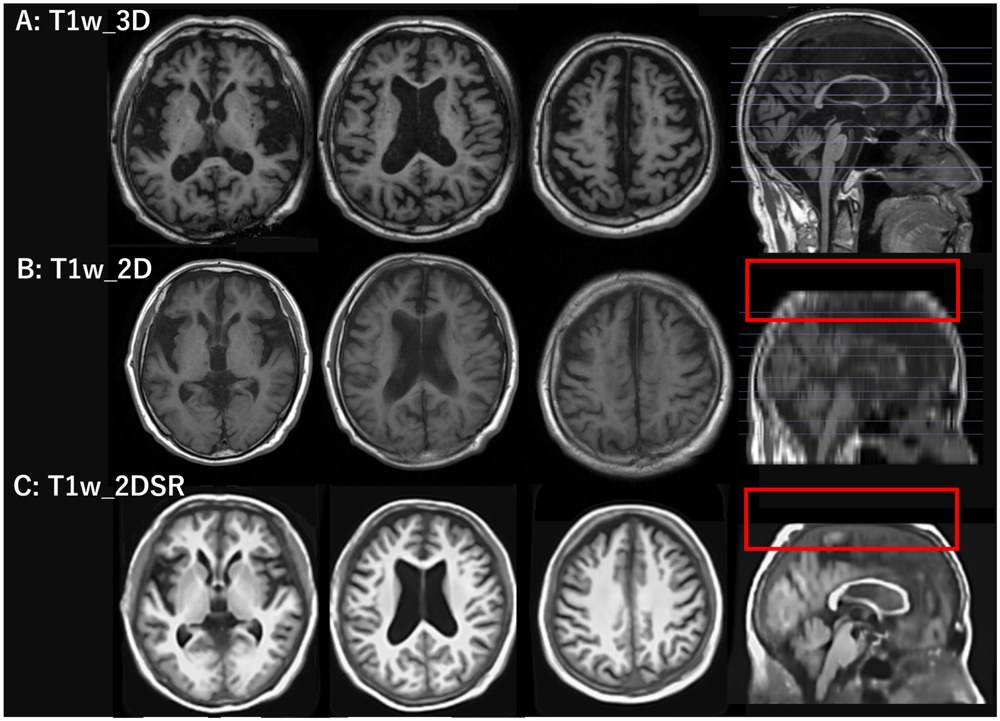2D→3D MRI 生成